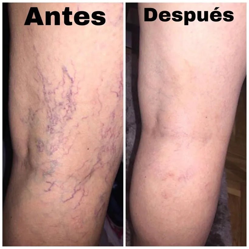 Spray Anti - Varices 100% Natural - Ecutienda.store